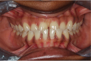 A close up of a person 's mouth with their teeth showing