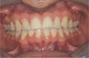 A close up of a person 's teeth with white teeth.