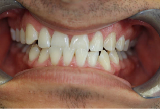 A close up of a person 's teeth with a mouth guard.