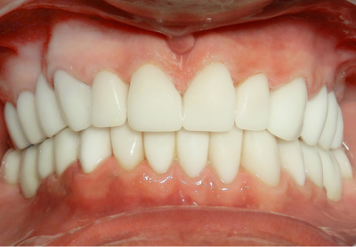 A close up of a person 's teeth with white teeth.