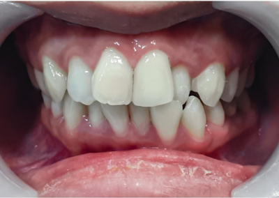 A close up of a person 's teeth with white teeth.