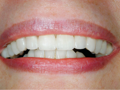 A close up of a person 's teeth with white teeth.