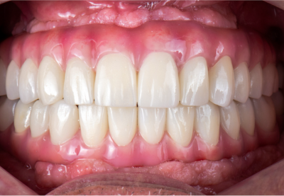 A close up of a person 's teeth with white teeth.