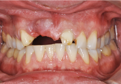 A close up of a person 's mouth with a missing tooth.