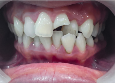 A close up of a person 's mouth with their teeth showing