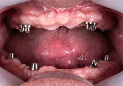 A close up of a person 's mouth with dental implants in it