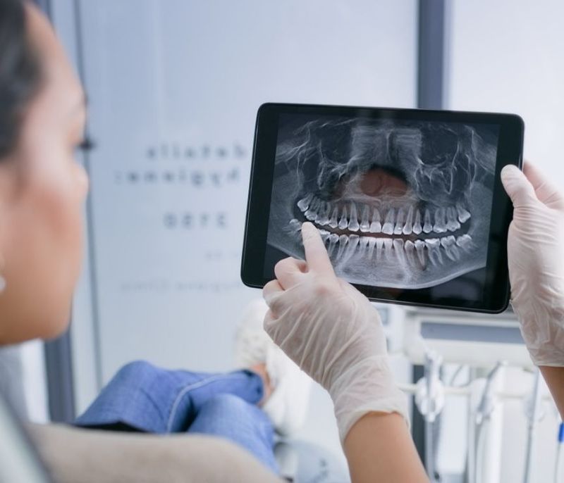 x-ray showing root canal