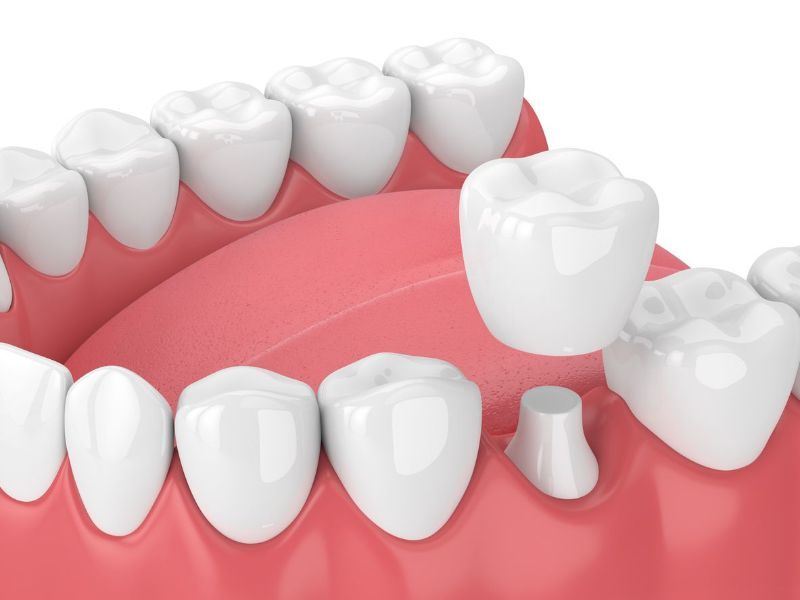 A close up of a dental bridge on a model of teeth.
