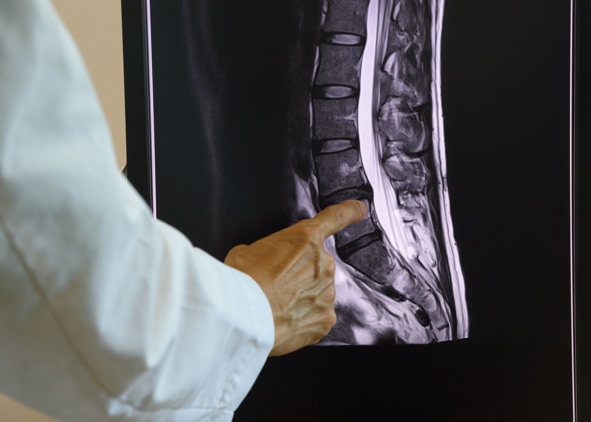 Cirurgia de coluna para descompressão nervosa em Nova Friburgo