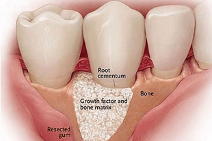 impronta protesi dentale