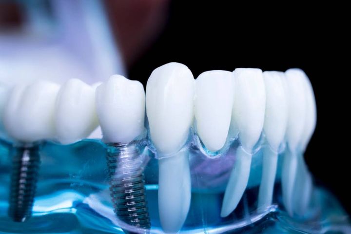 Modello dentale con intervento di implantologia visibile