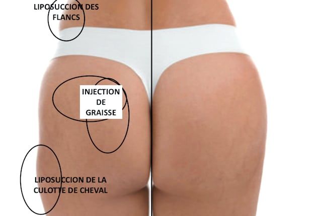 buttock lipofilling in bordeaux 