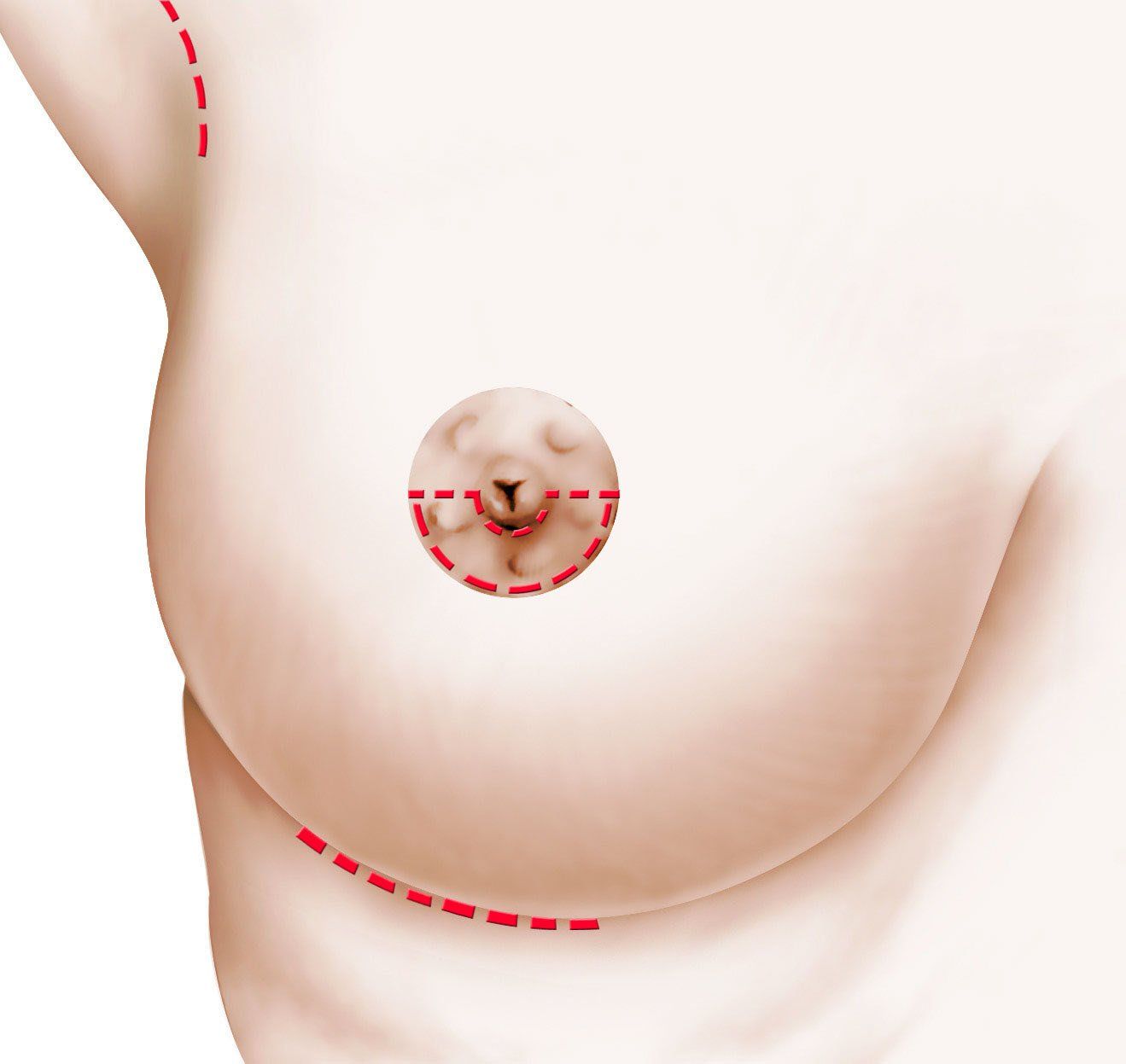 prothèse mammaire bordeaux sein