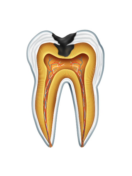 Help with cavities in Portage, Indiana