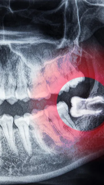 An x-ray of a person 's teeth with wisdom tooth growing in sideways