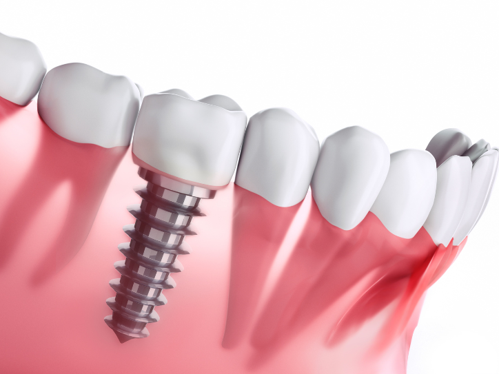 Dental Implants