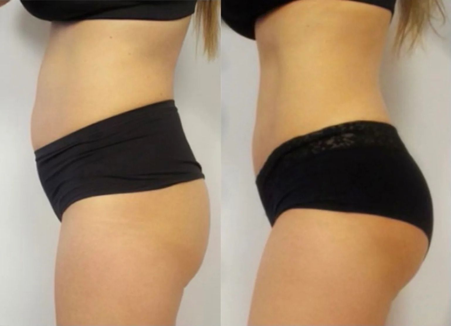 Abdomen And Buttocks