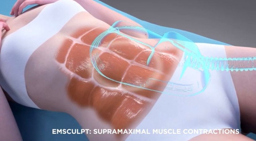 Lifting Treatment On Her Belly