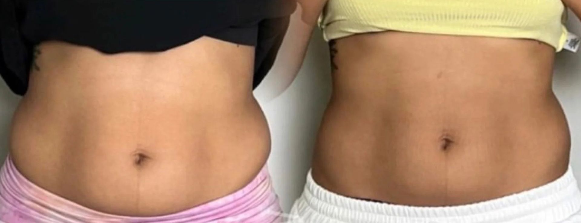 Stomach Before And After