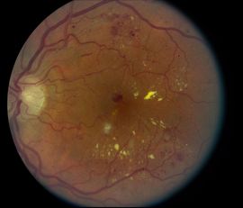 Diabetic Retinopathy Diabetic Retinopathy