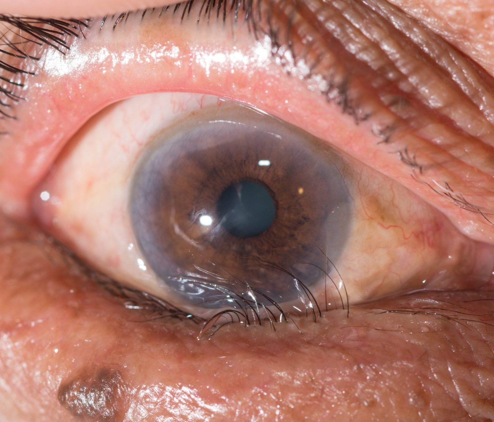Entropion of the lower eyelid
