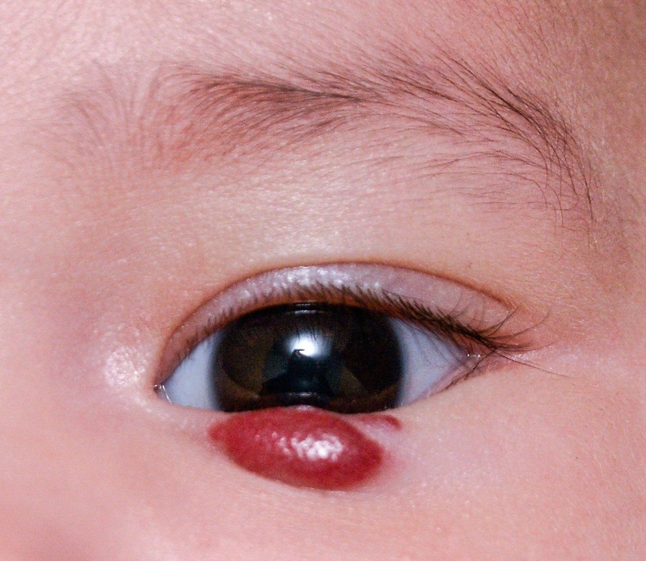 Eyelid hemangioma