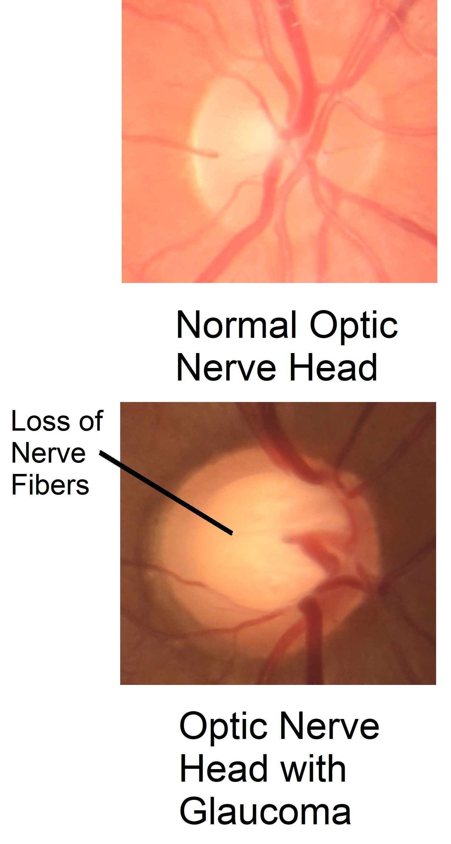 Optic Nerve Head with Glaucoma