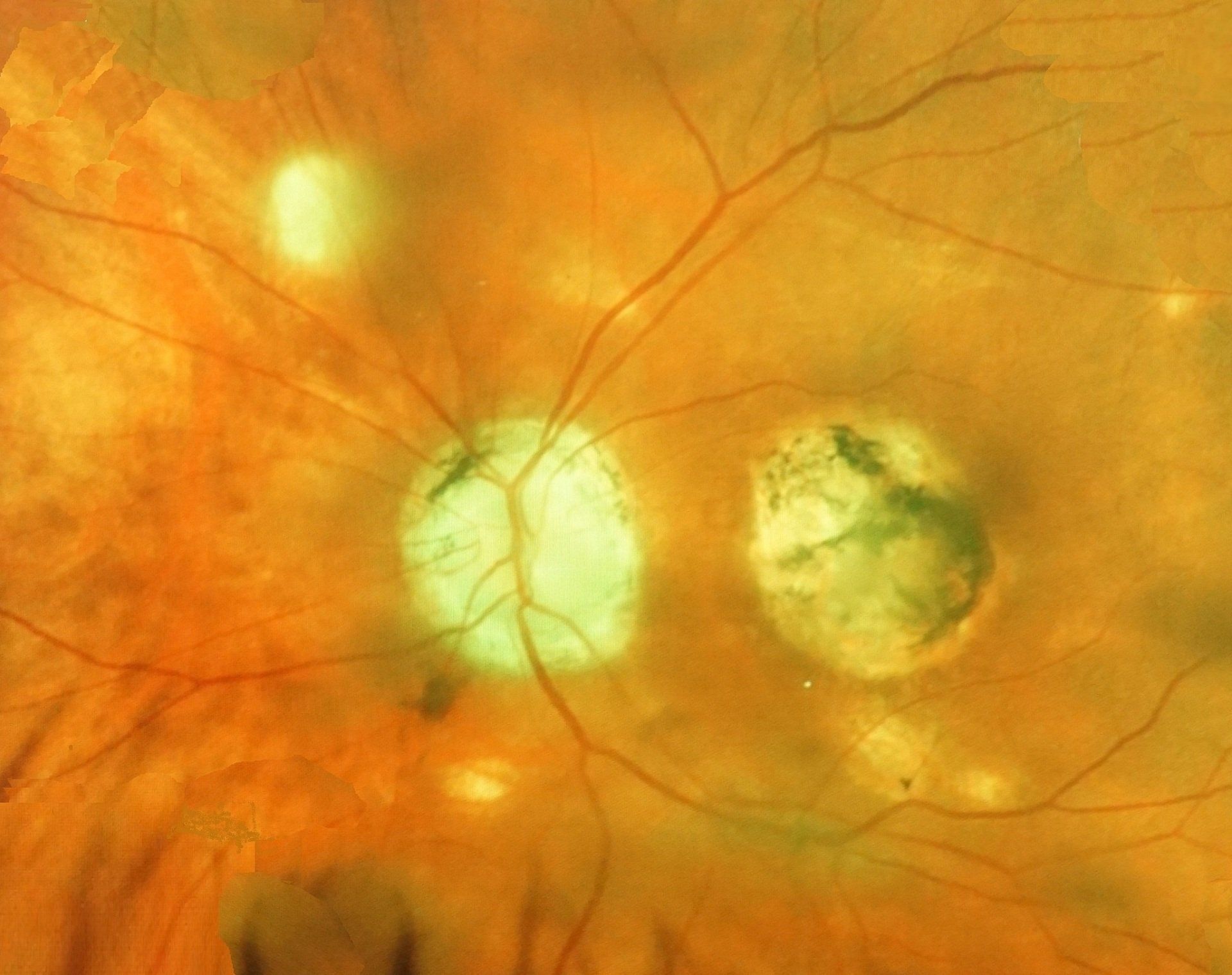 Ocular histoplasmosis