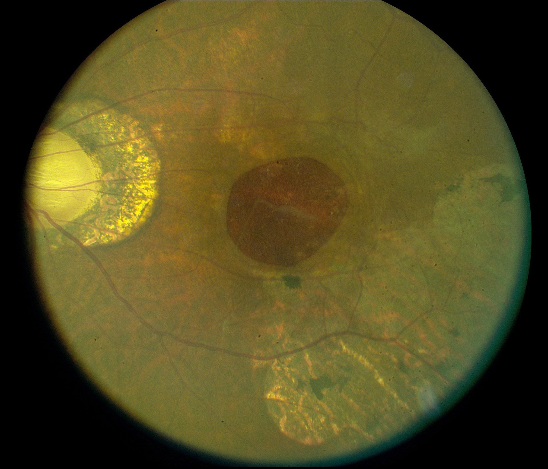 Large macular hole