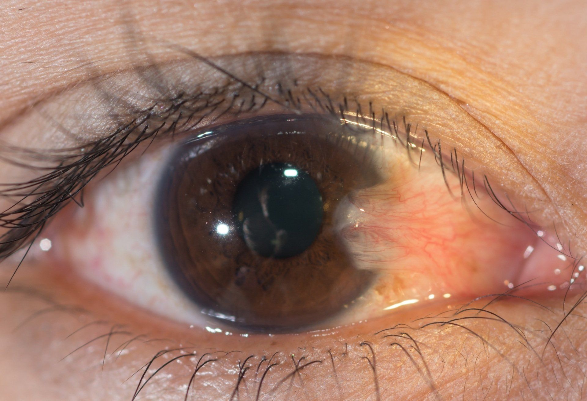 Pterygium in right eye
