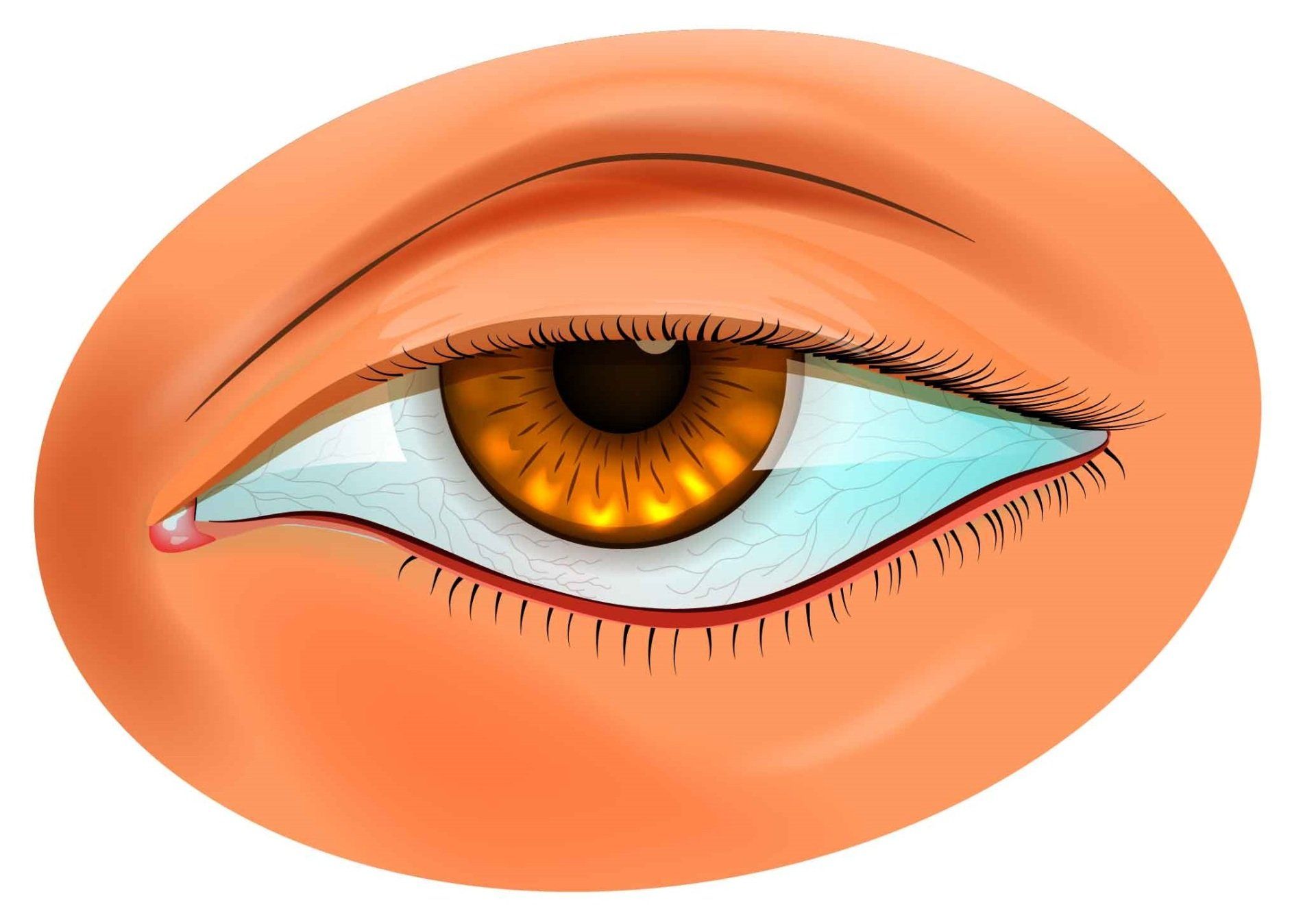 Ptosis showing drooping of the upper eyelid