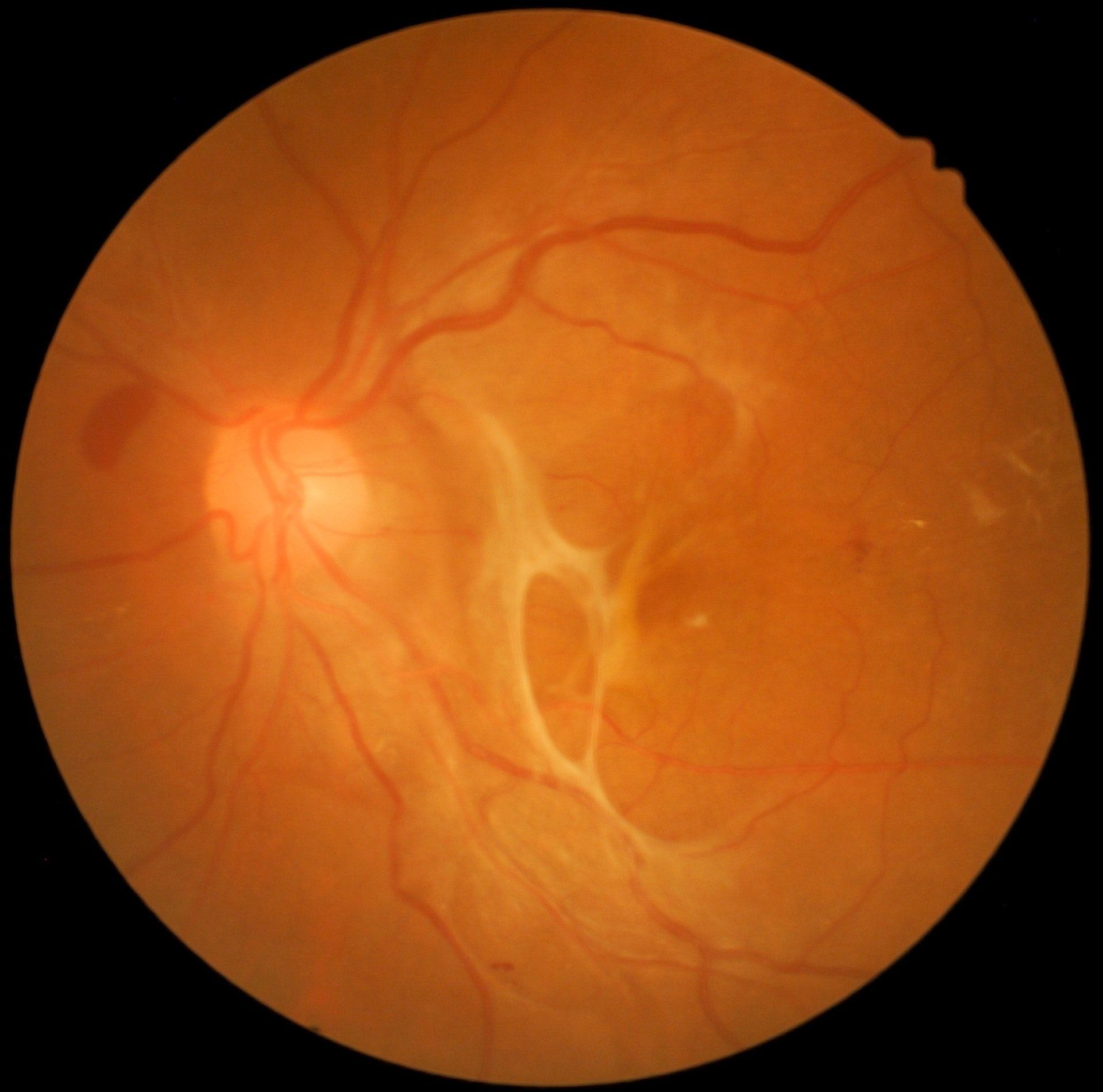 Tractional retinal detachment