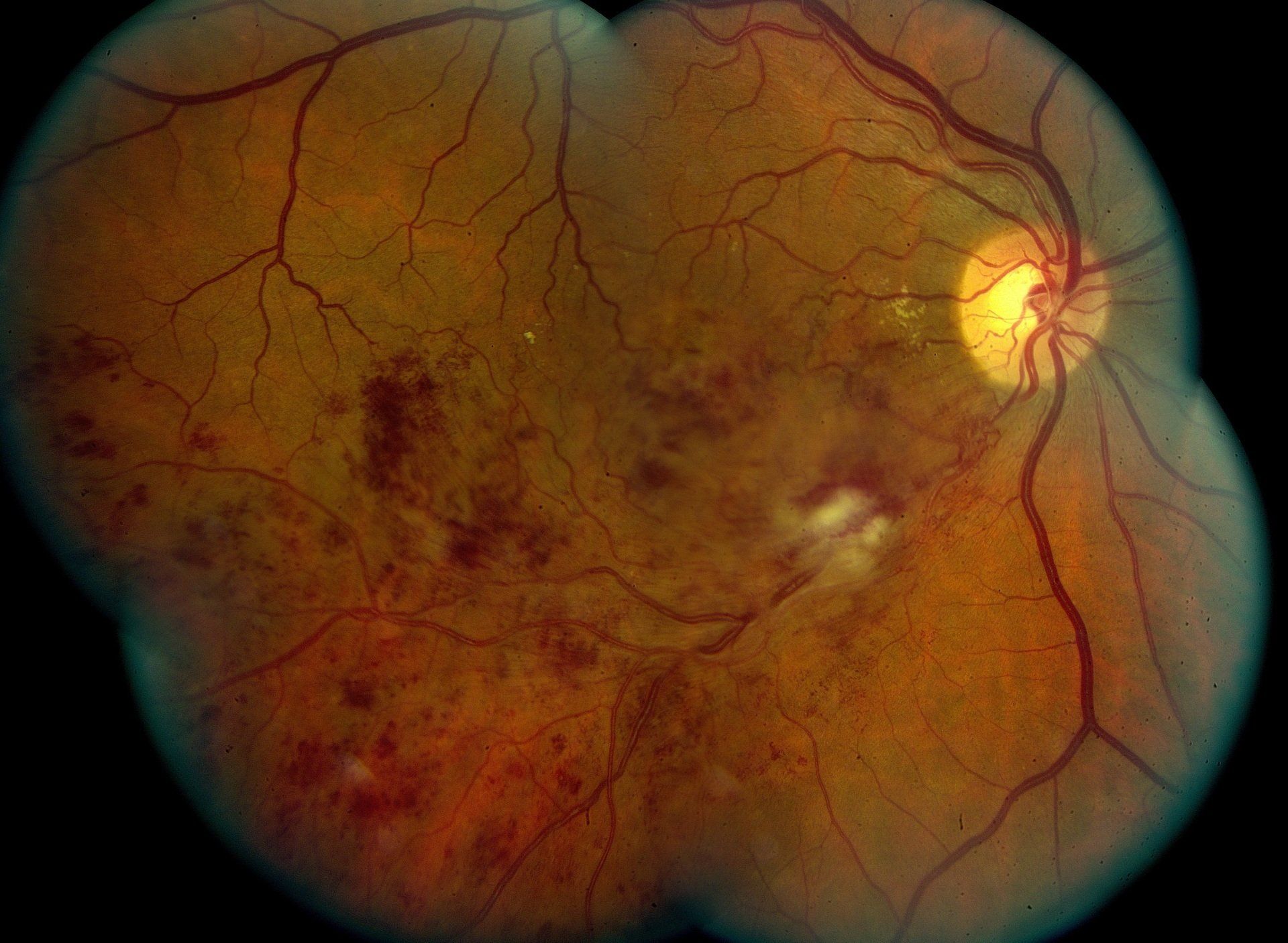 Retinal vein occlusion of the right eye