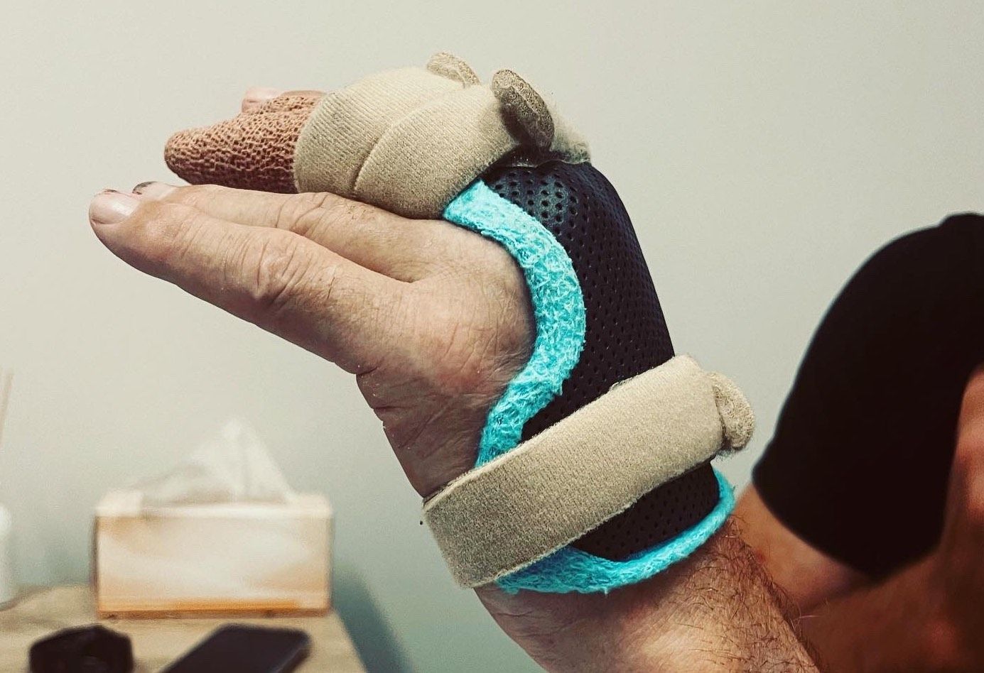 Hand in a hand splint— Occupational Therapist in Yeppoon, QLD