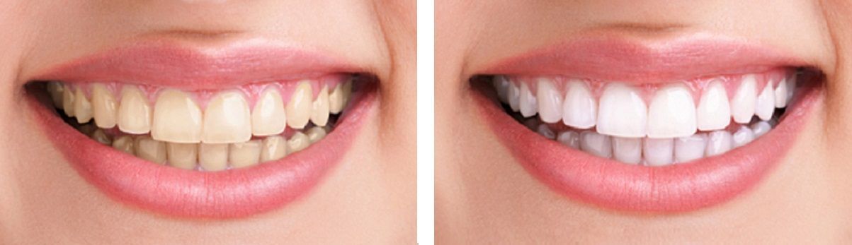 A woman 's teeth before and after whitening.