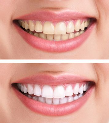 Comparison of teeth before and after whitening. Yellow teeth in top image, bright white in bottom image.
