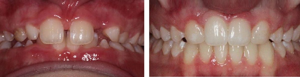 A before and after picture of a person 's teeth.