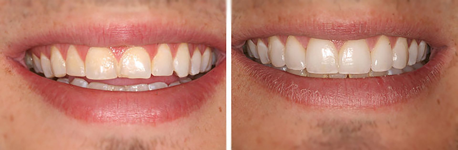 A before and after picture of a man 's teeth.