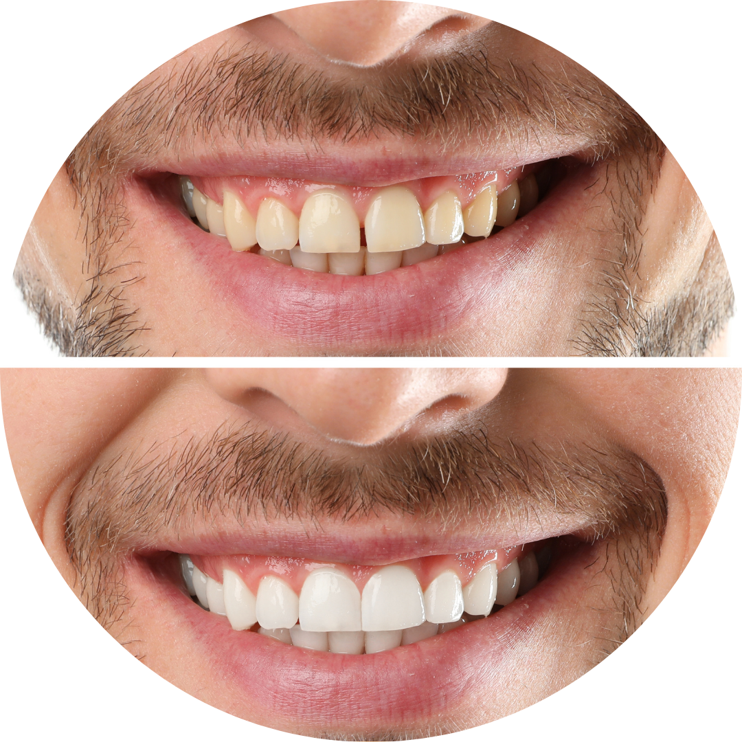 A before and after picture of a man 's teeth.