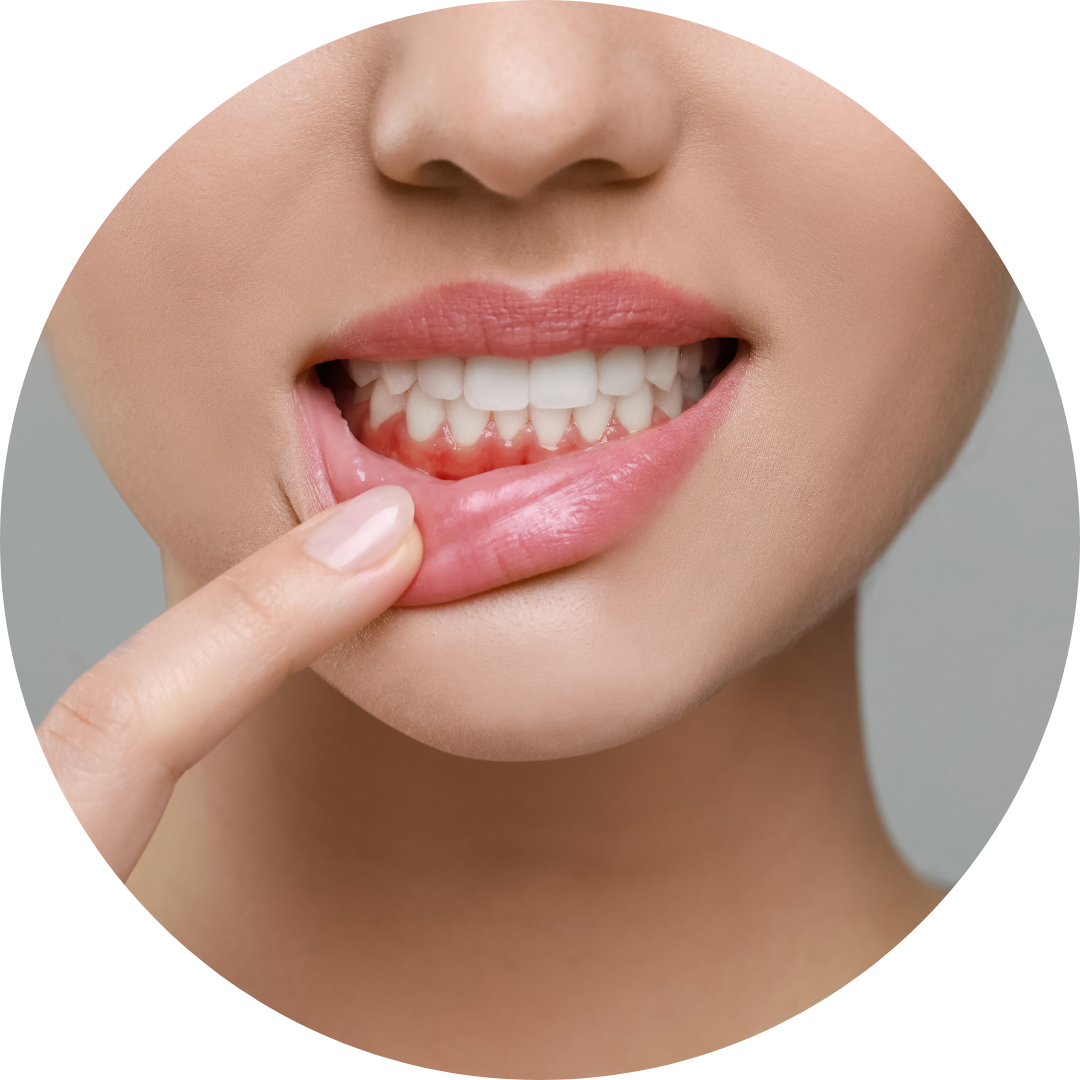 Woman pulling down bottom lip to show inflamed gum.