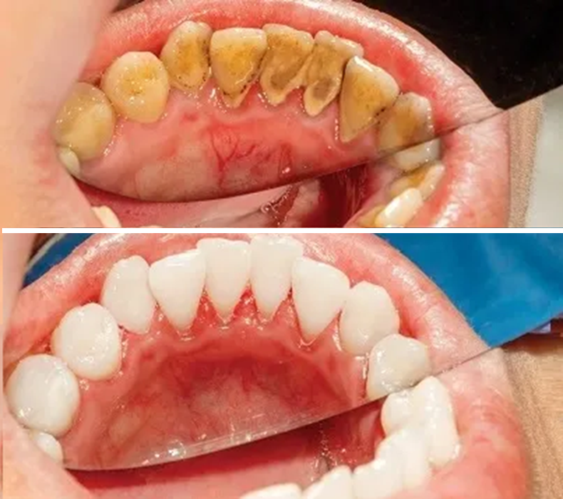 A before and after picture of a person 's teeth.