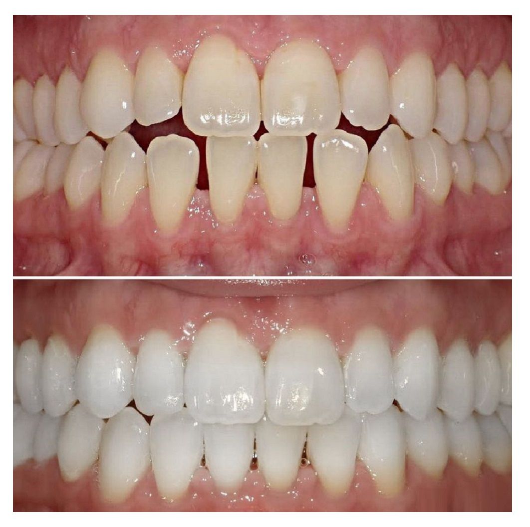 Side-by-side comparison of teeth. Top shows less white teeth; bottom shows brighter, whiter teeth, indicating whitening treatment.