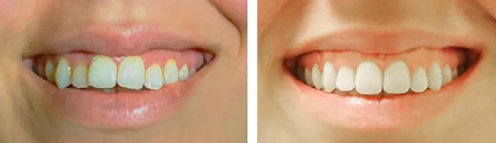 A before and after picture of a woman 's teeth.