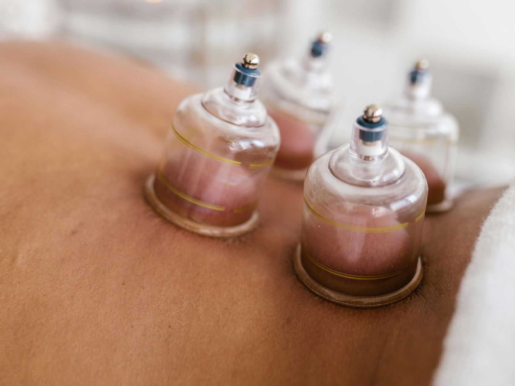 A person is getting cupping treatment on their back.
