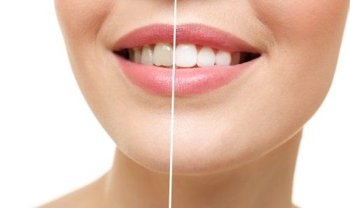 Prima e dopo il trattamento di sbiancamento dei denti