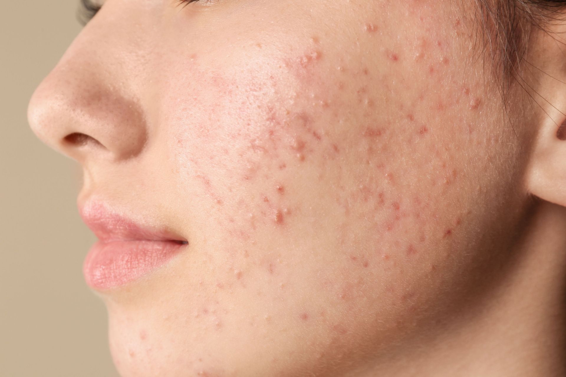 a close up of a woman 's face with acne on it .