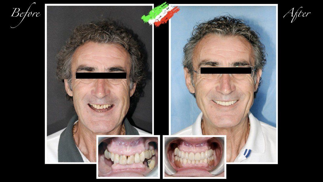 Ricostruzione di elementi dentali