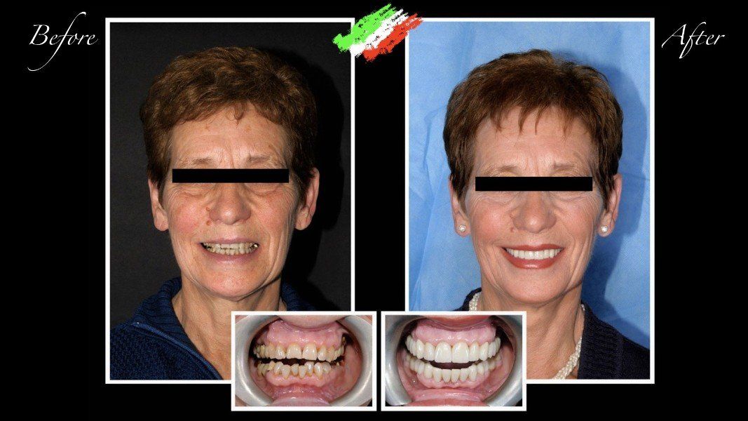 Ricostruzione di elementi dentali in paziente anziano
