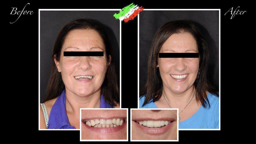 Intervento di estetica del sorriso