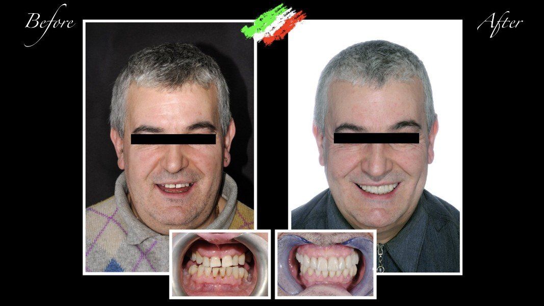 paziente prima e dopo impianto dentale